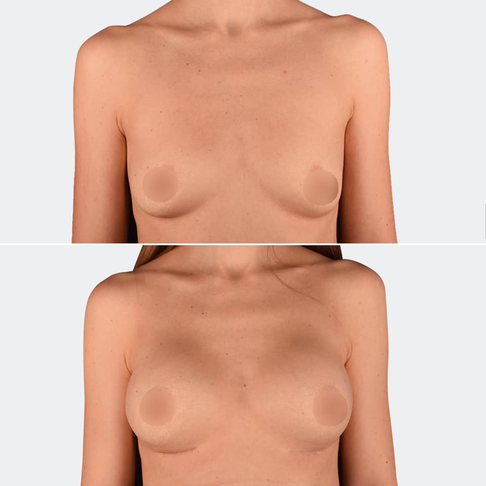 Фото до та після Мамопластика (Збільшення грудей) 15