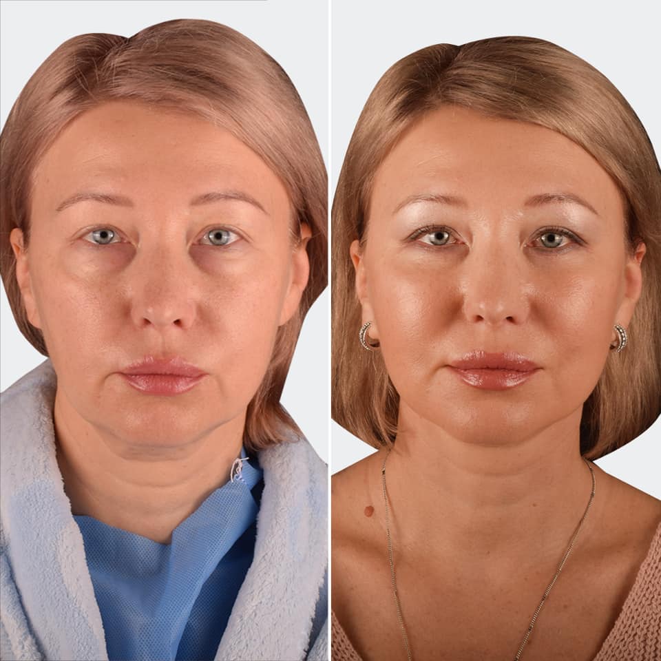 Фото до и после Подтяжка лица 7