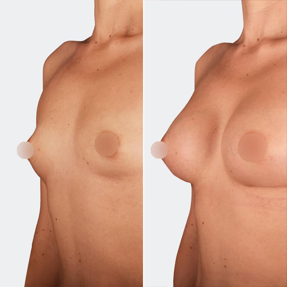 Фото до и после Маммопластика (увеличение груди) 5