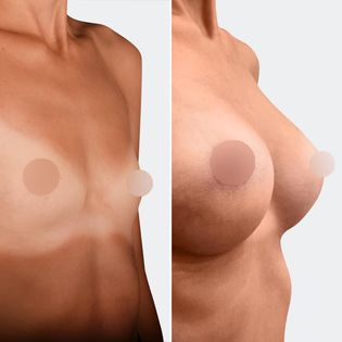 Фото до та після Мамопластика (Збільшення грудей) 9