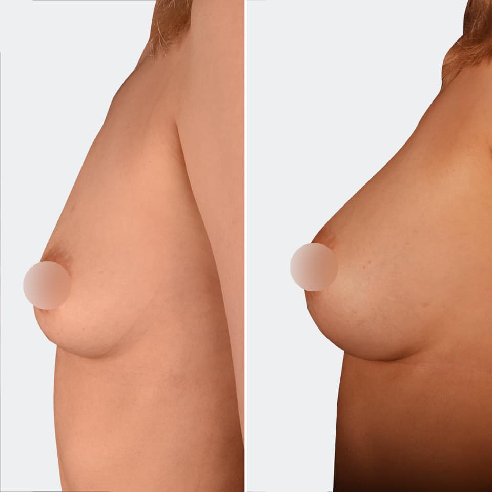Фото до и после Маммопластика (увеличение груди) 14