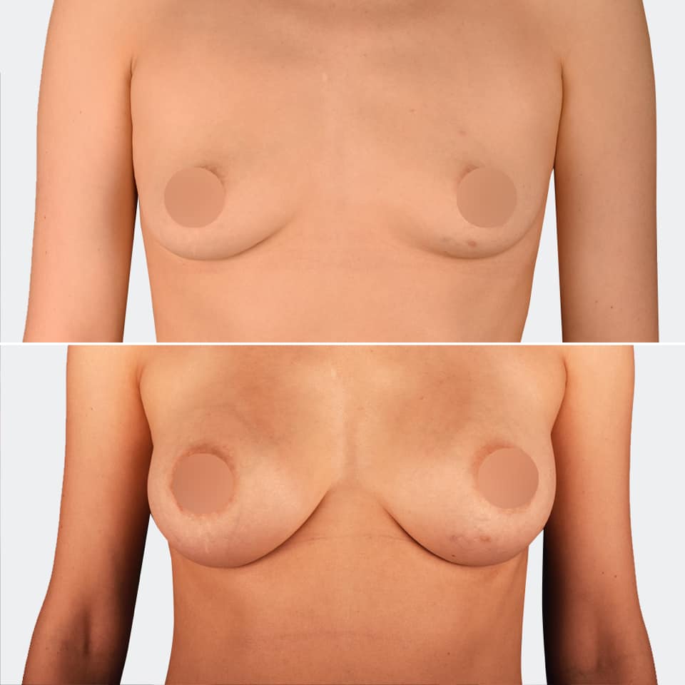 Фото до и после Маммопластика (увеличение груди) 18