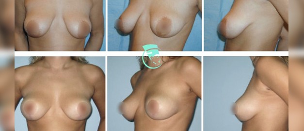 Фото до и после Подтяжка груди (мастопексия) 23