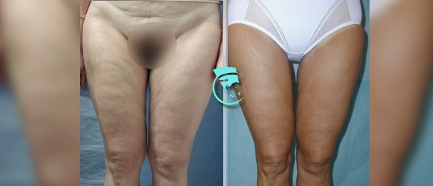 Photos before and after Thigh Lift 3