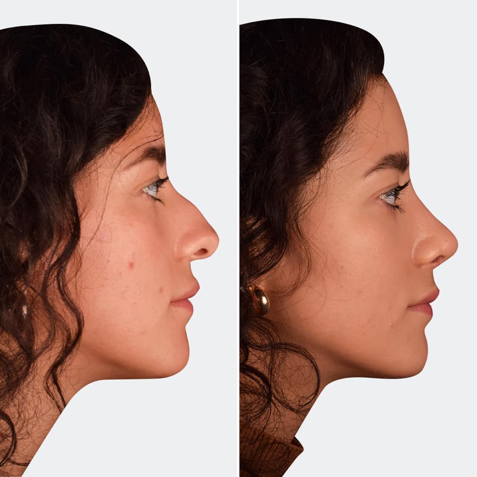 Фото до и после Ринопластика (пластика носа) 3