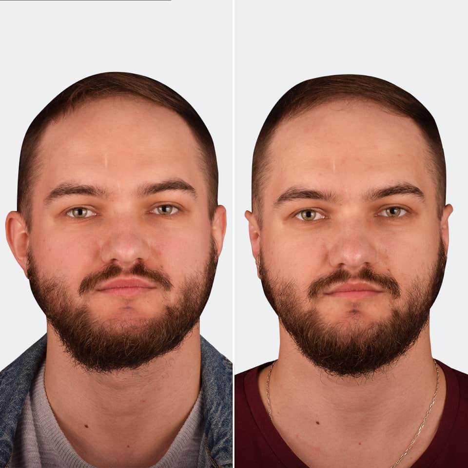 Фото до та після Пластика вух 3