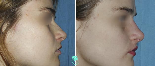 Фото до и после Ринопластика (пластика носа) 32