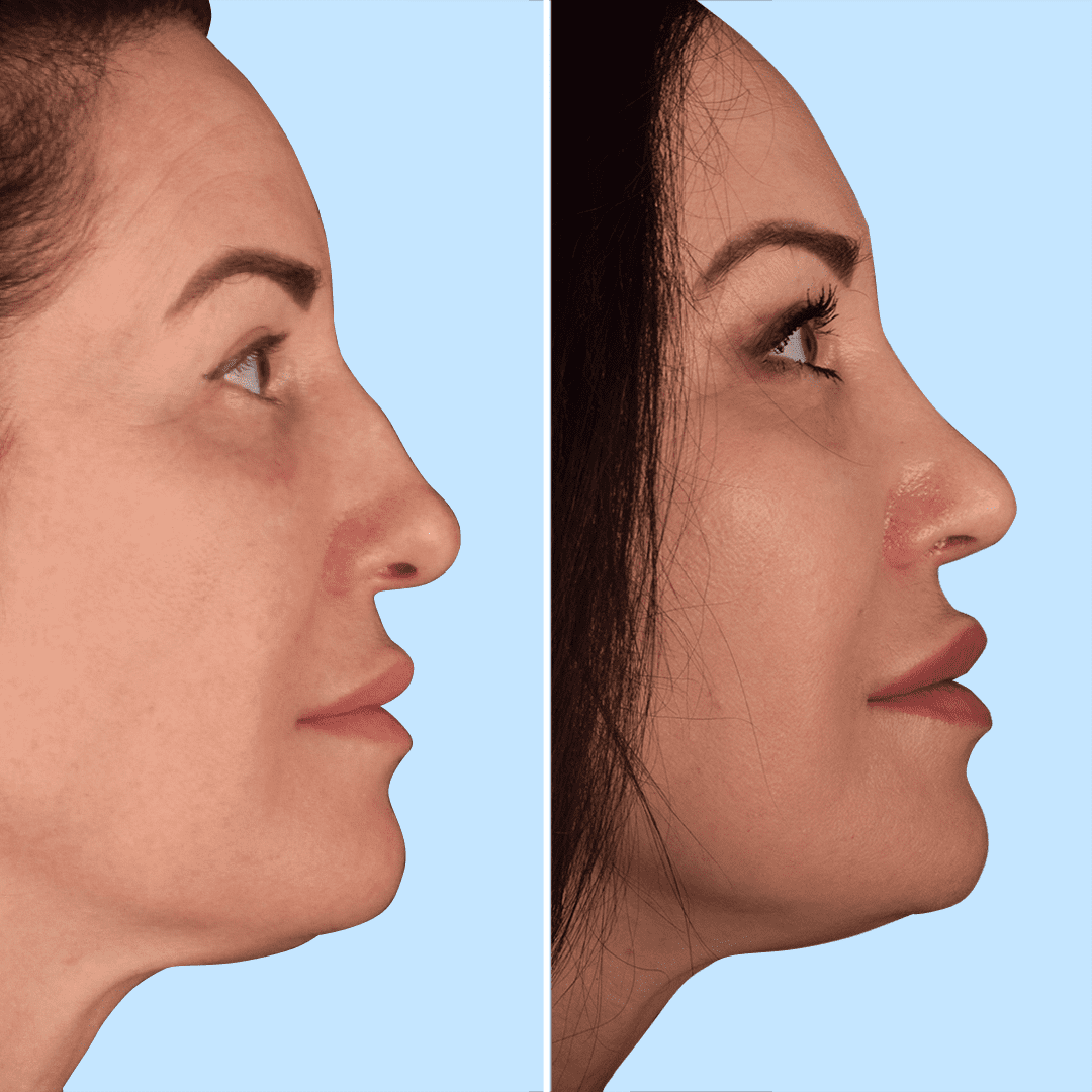 Фото до и после Ринопластика (пластика носа) 14