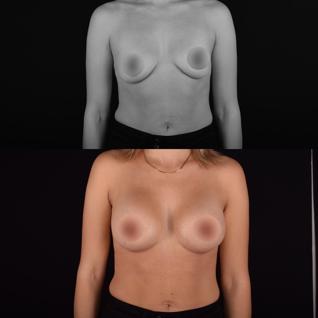 Фото до и после Маммопластика (увеличение груди) 2