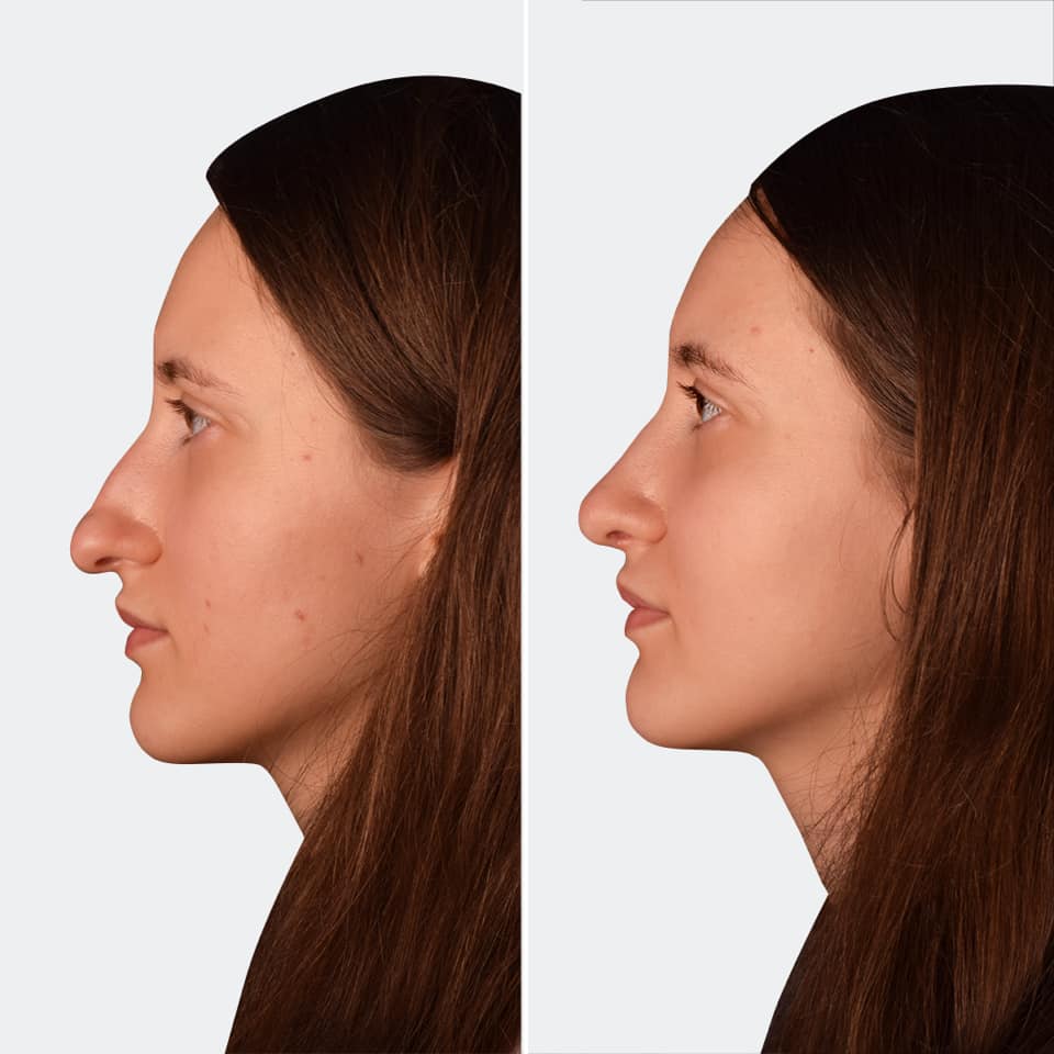 Фото до и после Ринопластика (пластика носа) 4