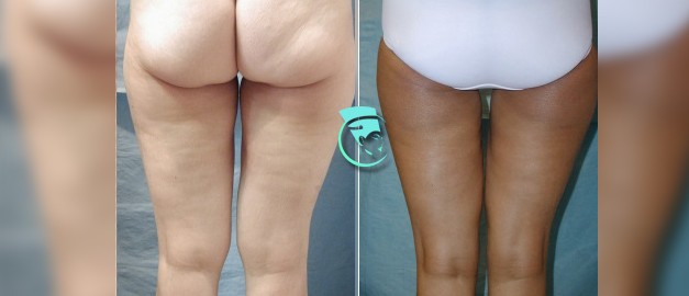 Photos before and after Thigh Lift 4