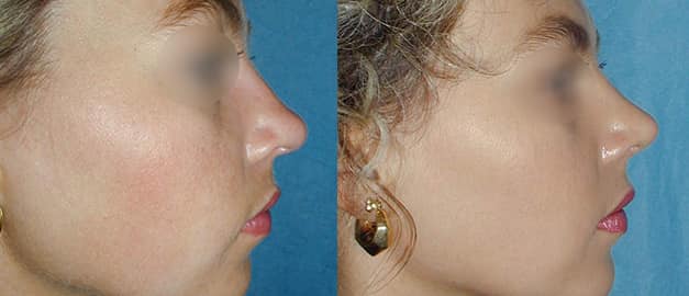 Фото до и после Ринопластика (пластика носа) 33