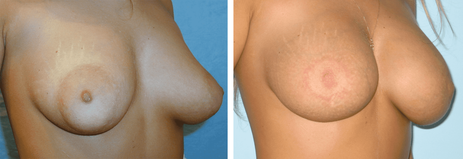 Photos before and after Nipple Correction/Areola correction 3