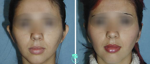 Фото до та після Пластика вух 15