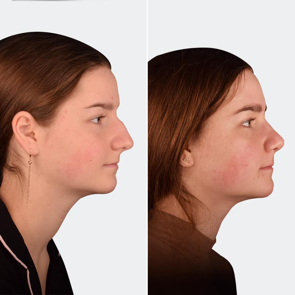 Фото до и после Ринопластика (пластика носа) 5