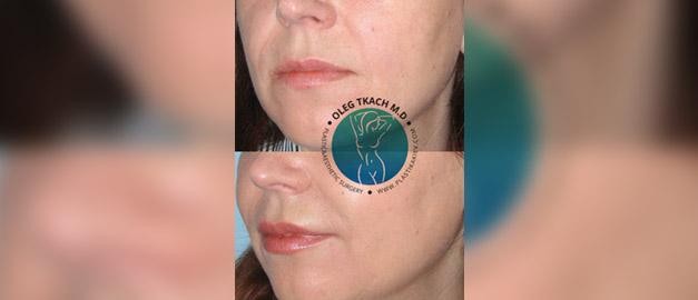 Photos before and after Filler Injections 14