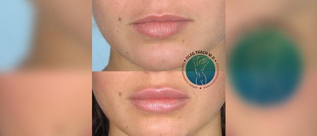 Photos before and after Filler Injections 18