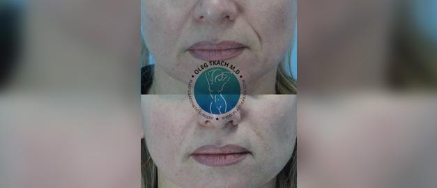 Photos before and after Filler Injections 19