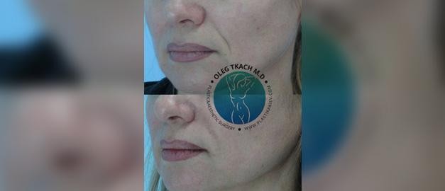 Photos before and after Filler Injections 20
