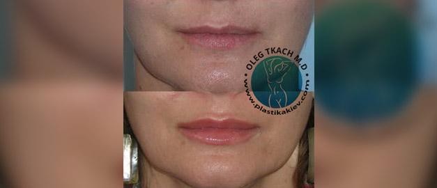 Photos before and after Filler Injections 23