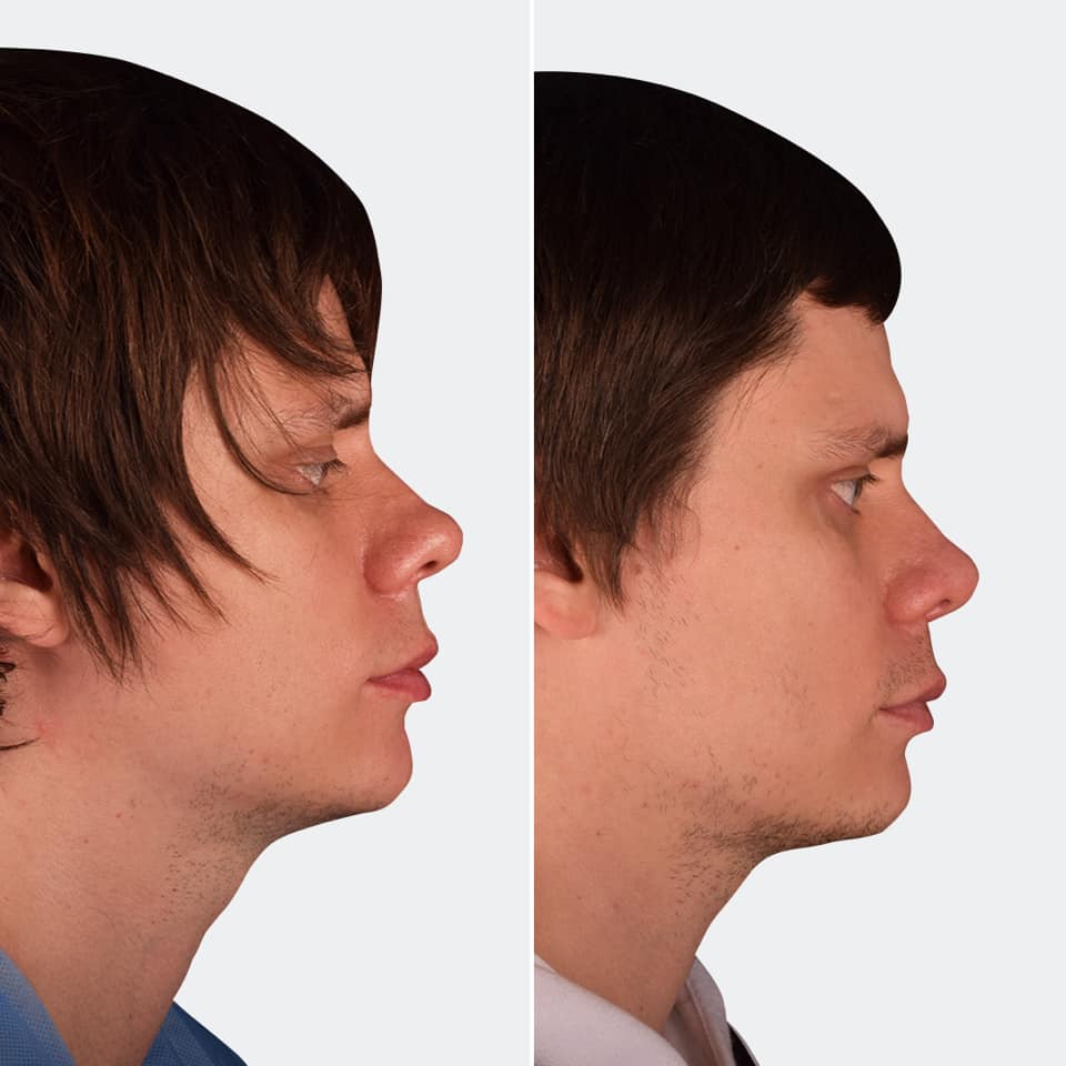 Фото до и после Ринопластика (пластика носа) 6
