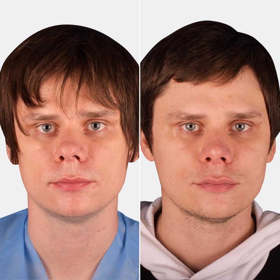 Фото до и после Ринопластика (пластика носа) 7