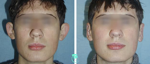Фото до та після Пластика вух 18