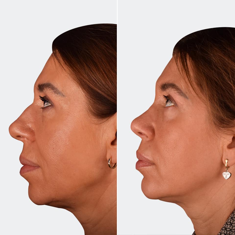 Фото до и после Ринопластика (пластика носа) 8