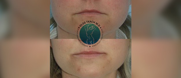 Photos before and after Filler Injections 25