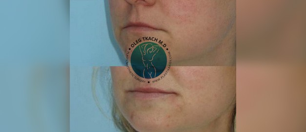 Photos before and after Filler Injections 26