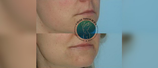 Photos before and after Filler Injections 27