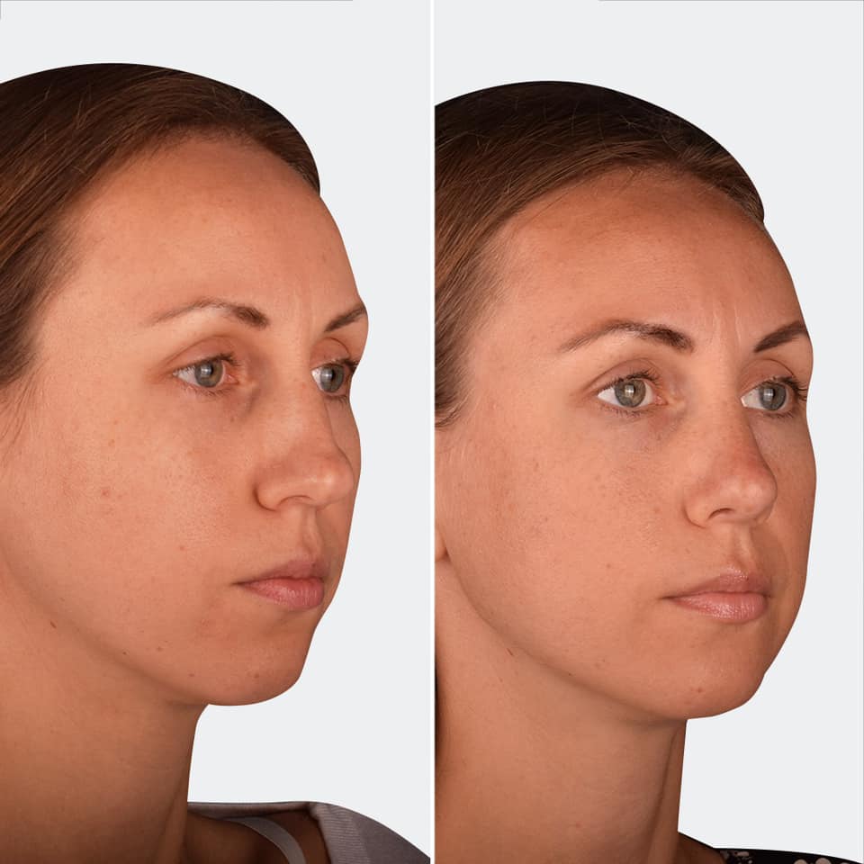 Фото до та після Ринопластика (пластика носа) 9