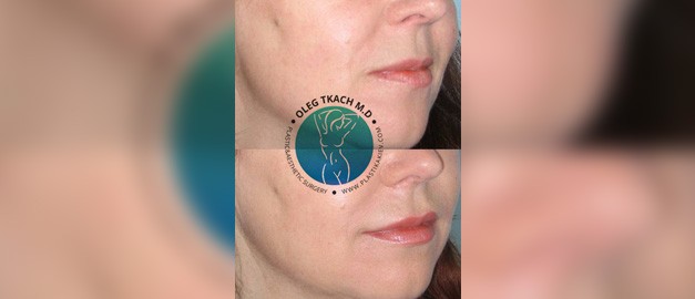 Photos before and after Filler Injections 28