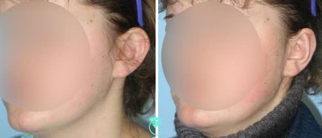 Фото до та після Пластика вух 36