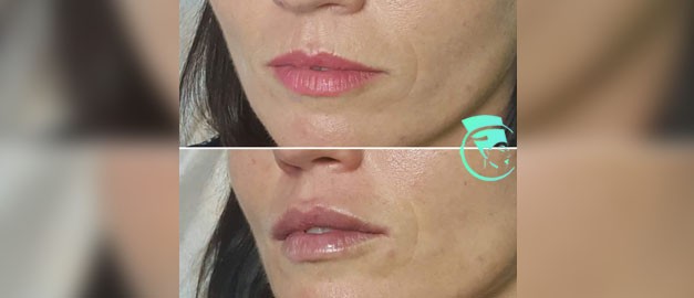 Photos before and after Filler Injections 4