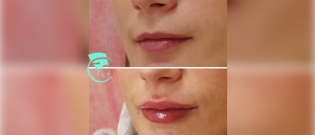 Photos before and after Filler Injections 5