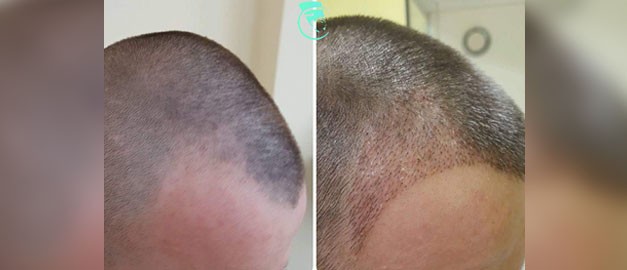 Фото до та після Пересадка волосся 1
