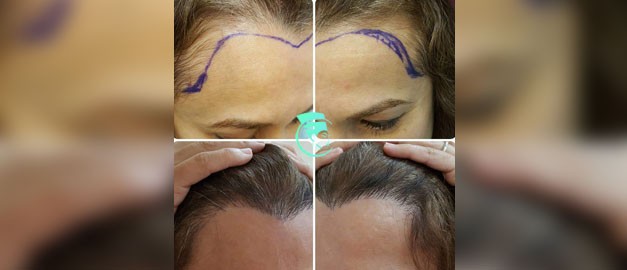 Фото до та після Пересадка волосся 5