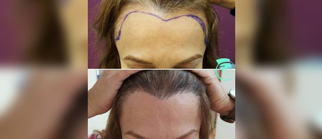 Фото до та після Пересадка волосся 6