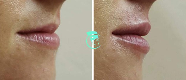 Photos before and after Filler Injections 6