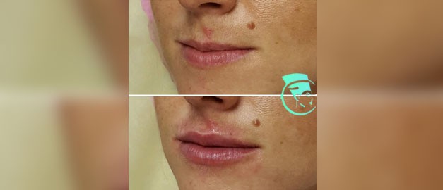 Photos before and after Filler Injections 7