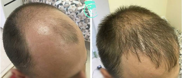 Фото до та після Пересадка волосся 3