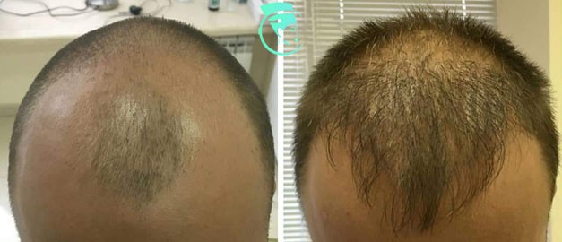 Фото до та після Пересадка волосся 2