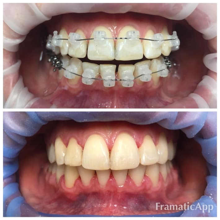 Фото до и после Ортодонтия 1