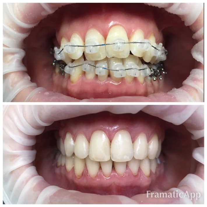 Photos before and after Orthodontology 2