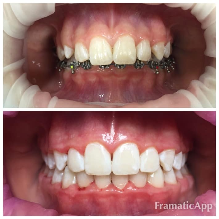 Photos before and after Orthodontology 3