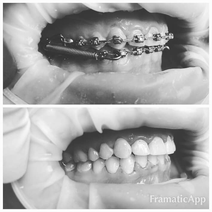 Photos before and after Orthodontology 4