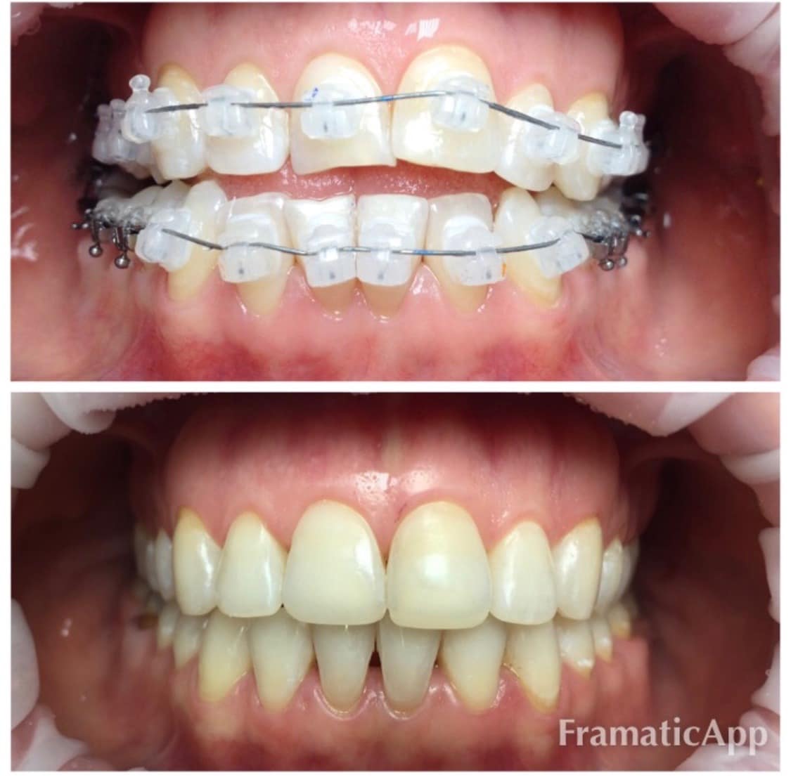 Photos before and after Orthodontology 5