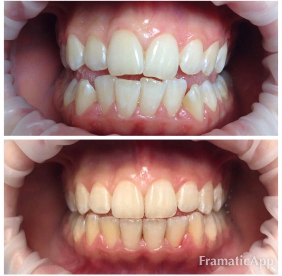 Photos before and after Orthodontology 6