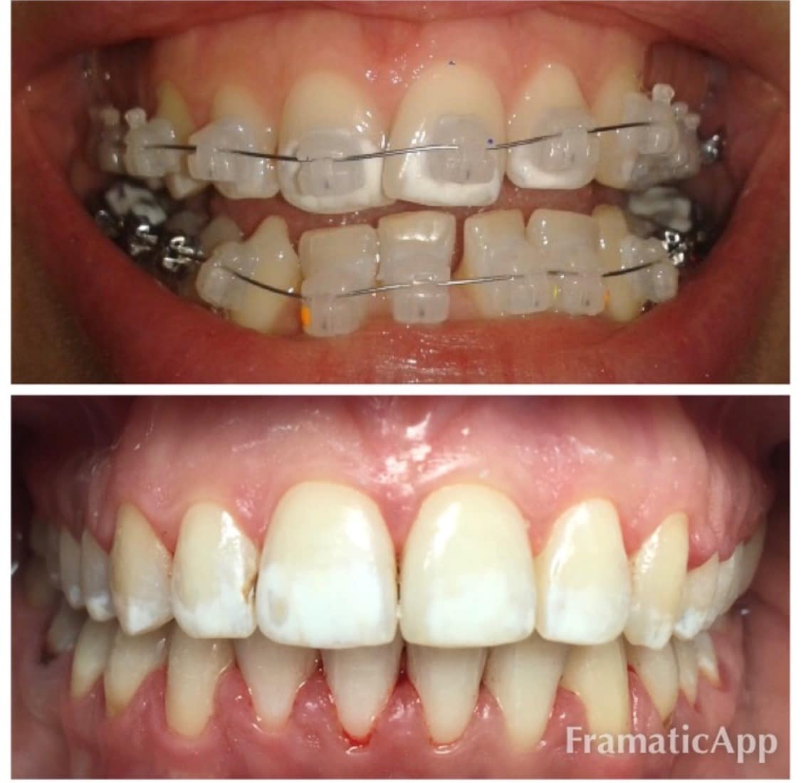 Photos before and after Orthodontology 7